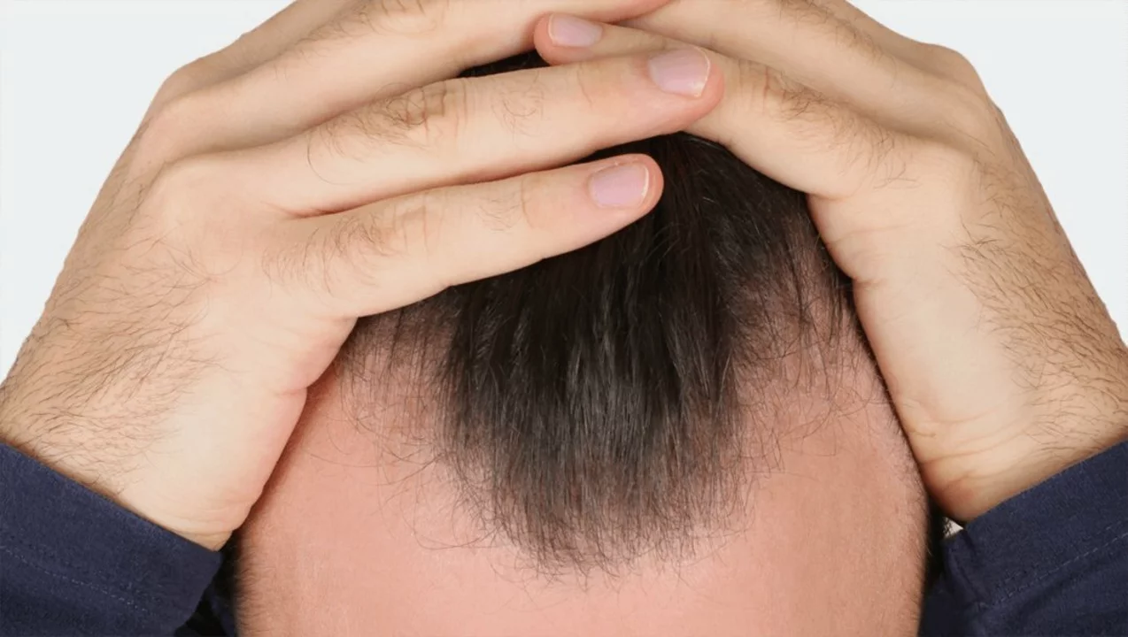 Hair Loss and Baldness: How to grow receding hairline?